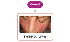 Systemic Lupus Erythematosus Fever Rash: Mnemonic [NEVER FORGET AGAIN]