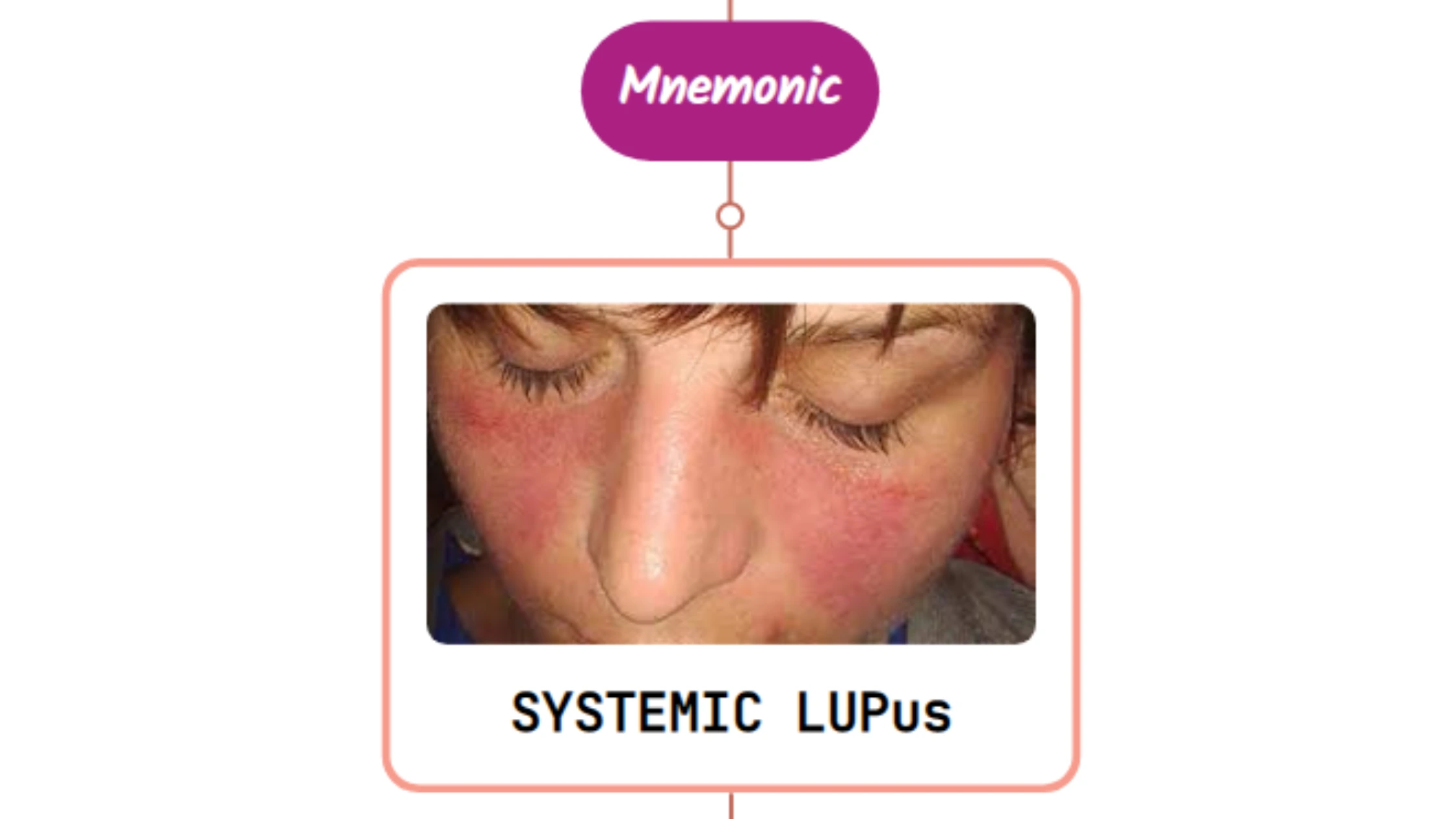 You are currently viewing Systemic Lupus Erythematosus Fever Rash: Mnemonic [NEVER FORGET AGAIN]
