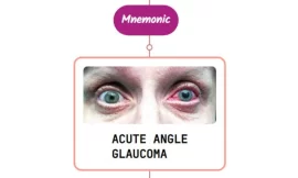 Acute Angle-Closure Glaucoma Mnemonic