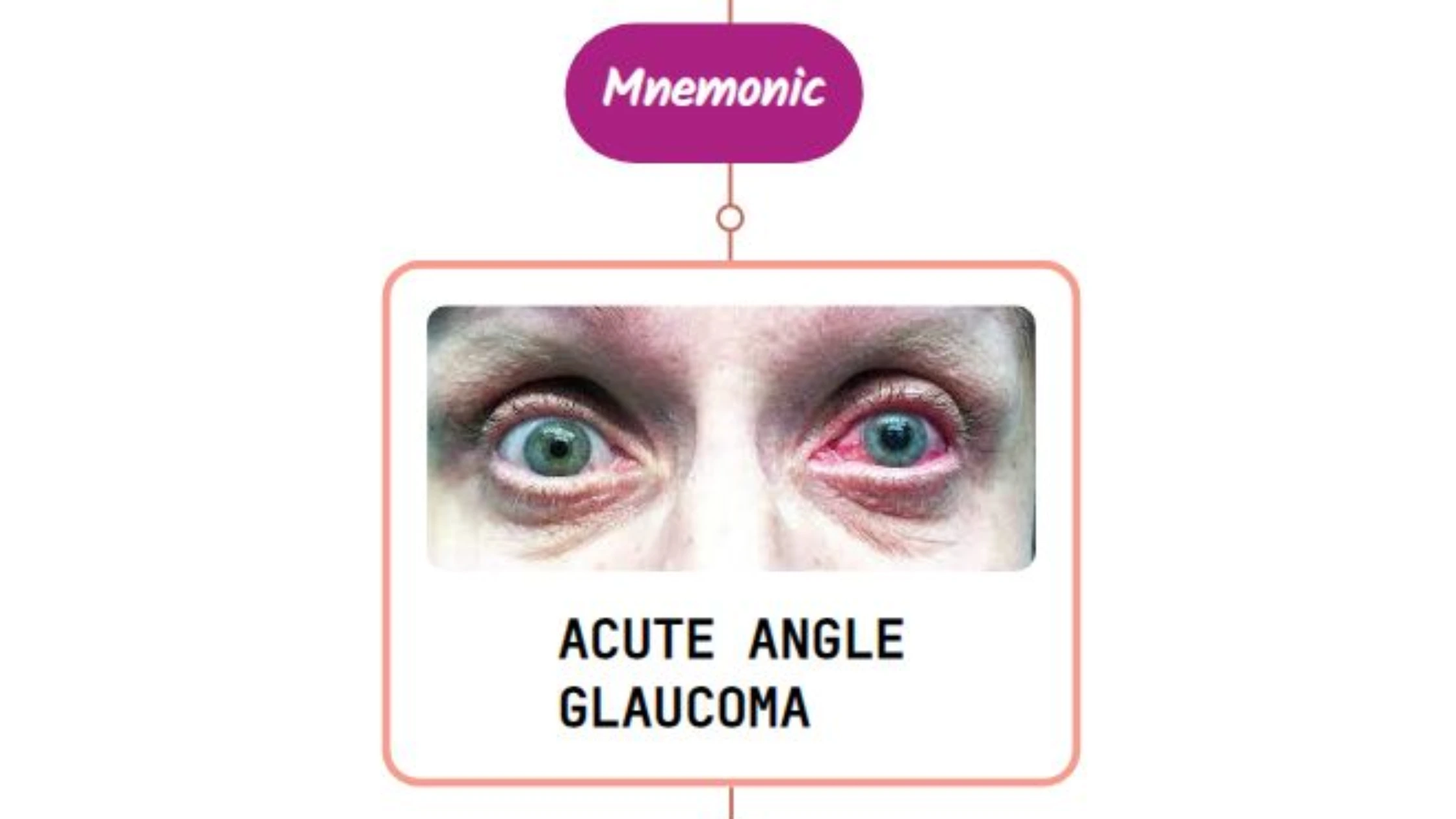 You are currently viewing Acute Angle-Closure Glaucoma Mnemonic