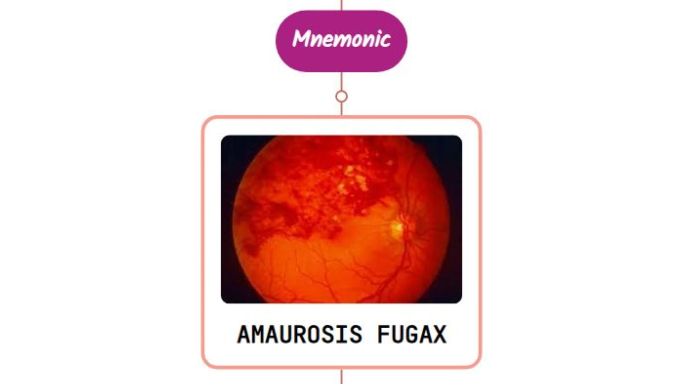 You are currently viewing Amaurosis Fugax Mnemonic