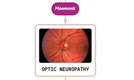 Anterior Ischemic Optic Neuropathy Mnemonic