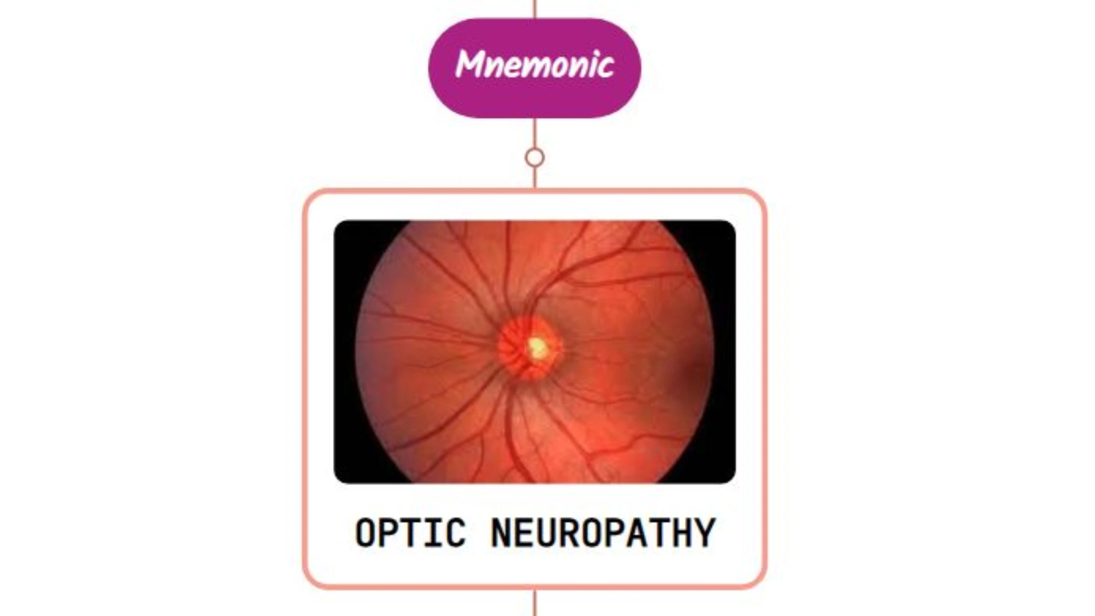You are currently viewing Anterior Ischemic Optic Neuropathy Mnemonic