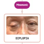 Read more about the article Blepharoptosis – Mnemonic