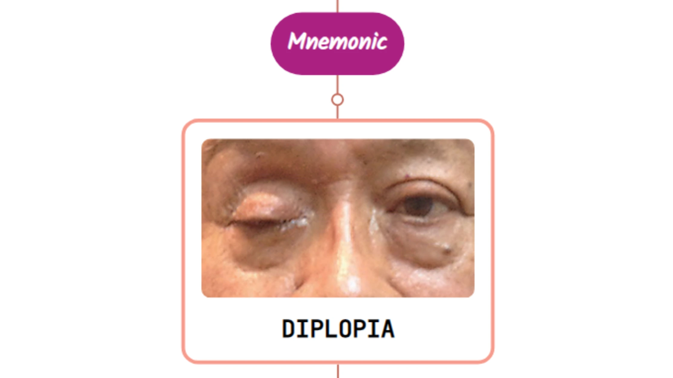 You are currently viewing Blepharoptosis – Mnemonic