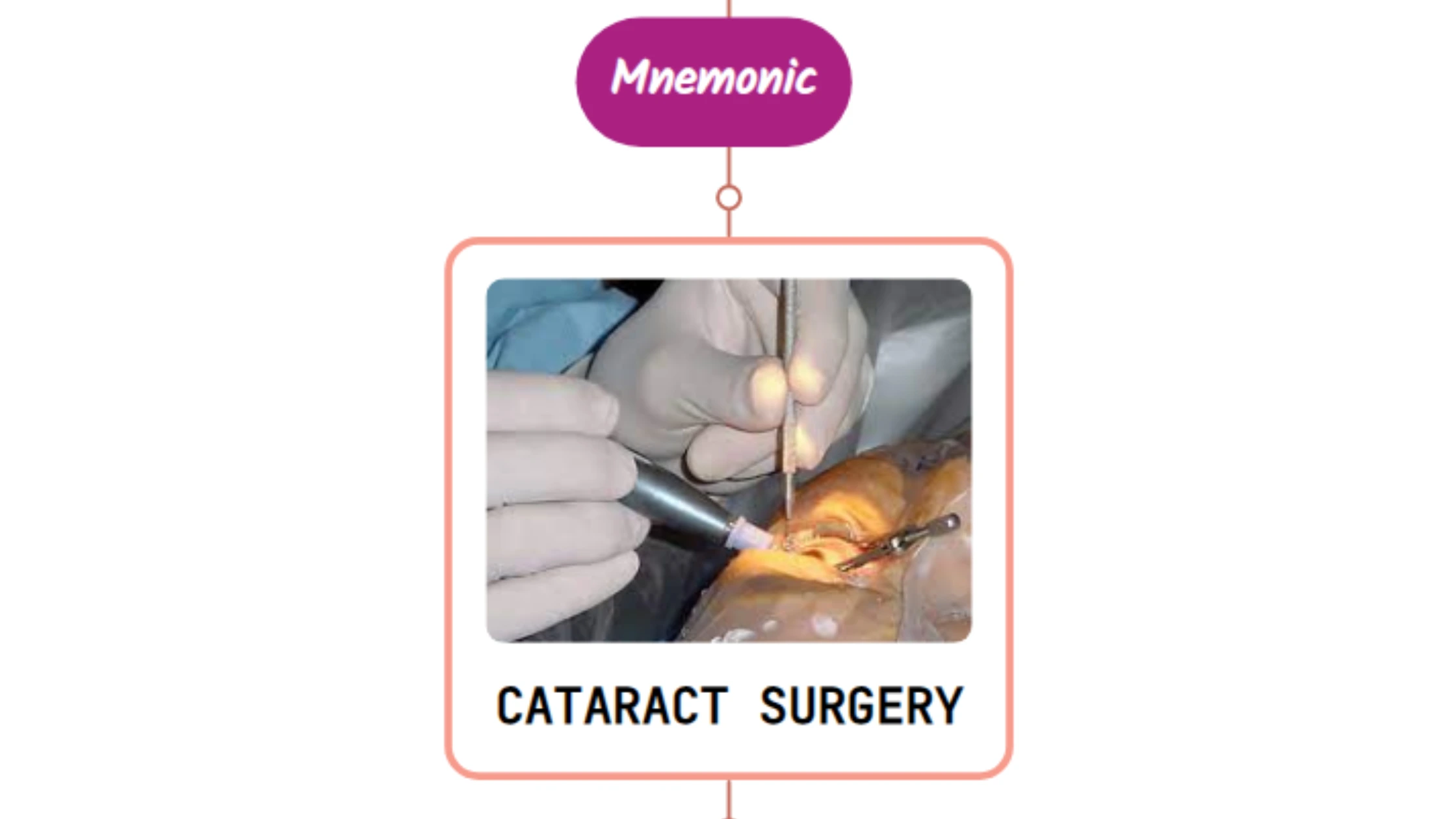 You are currently viewing Cataract – Mnemonic