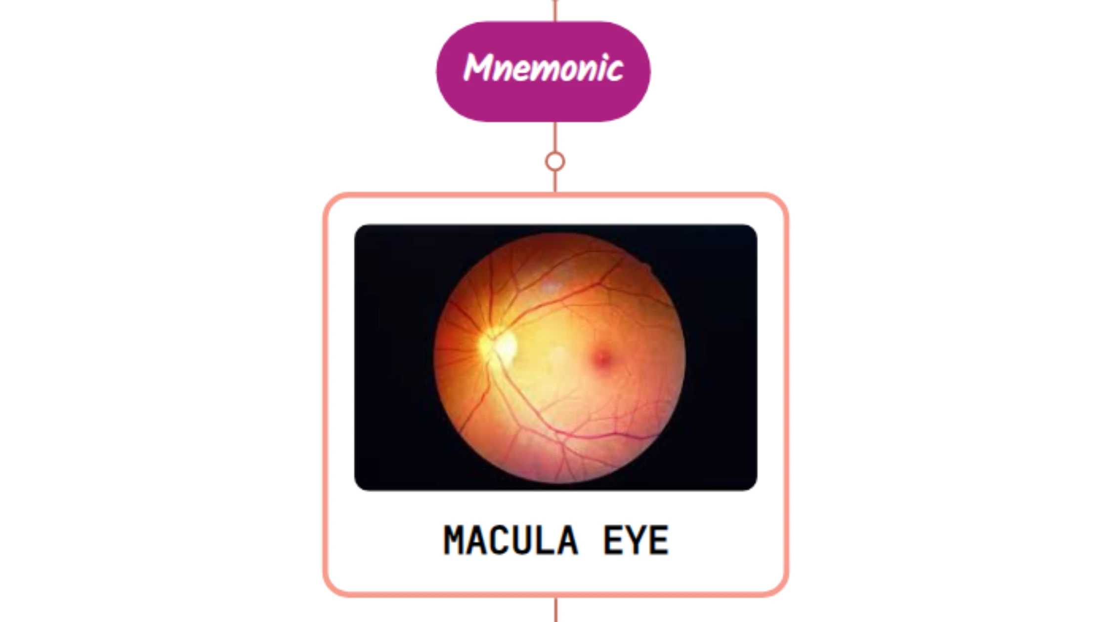 You are currently viewing Central Serous Chorioretinopathy – Mnemonic