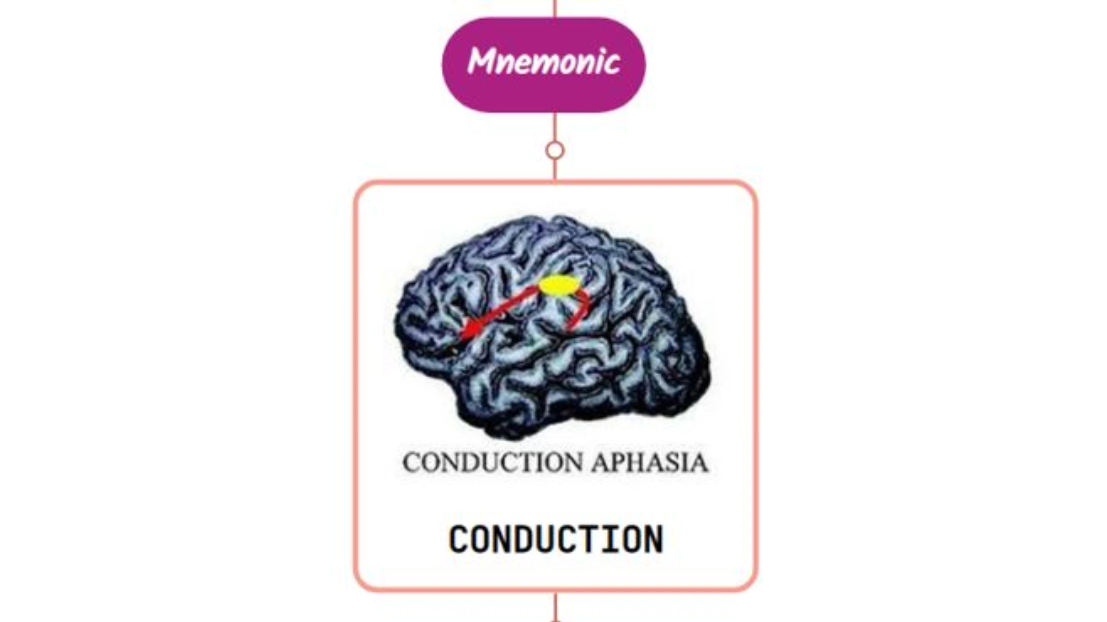 You are currently viewing Conduction Aphasia Mnemonic