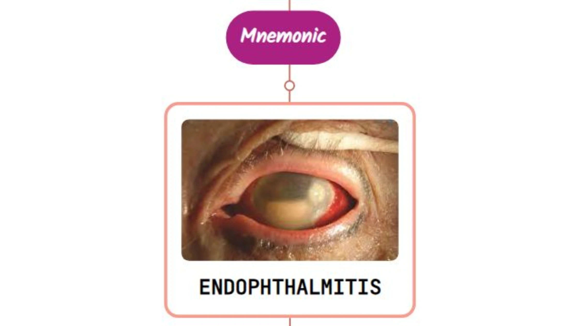 You are currently viewing Endophthalmitis Mnemonic