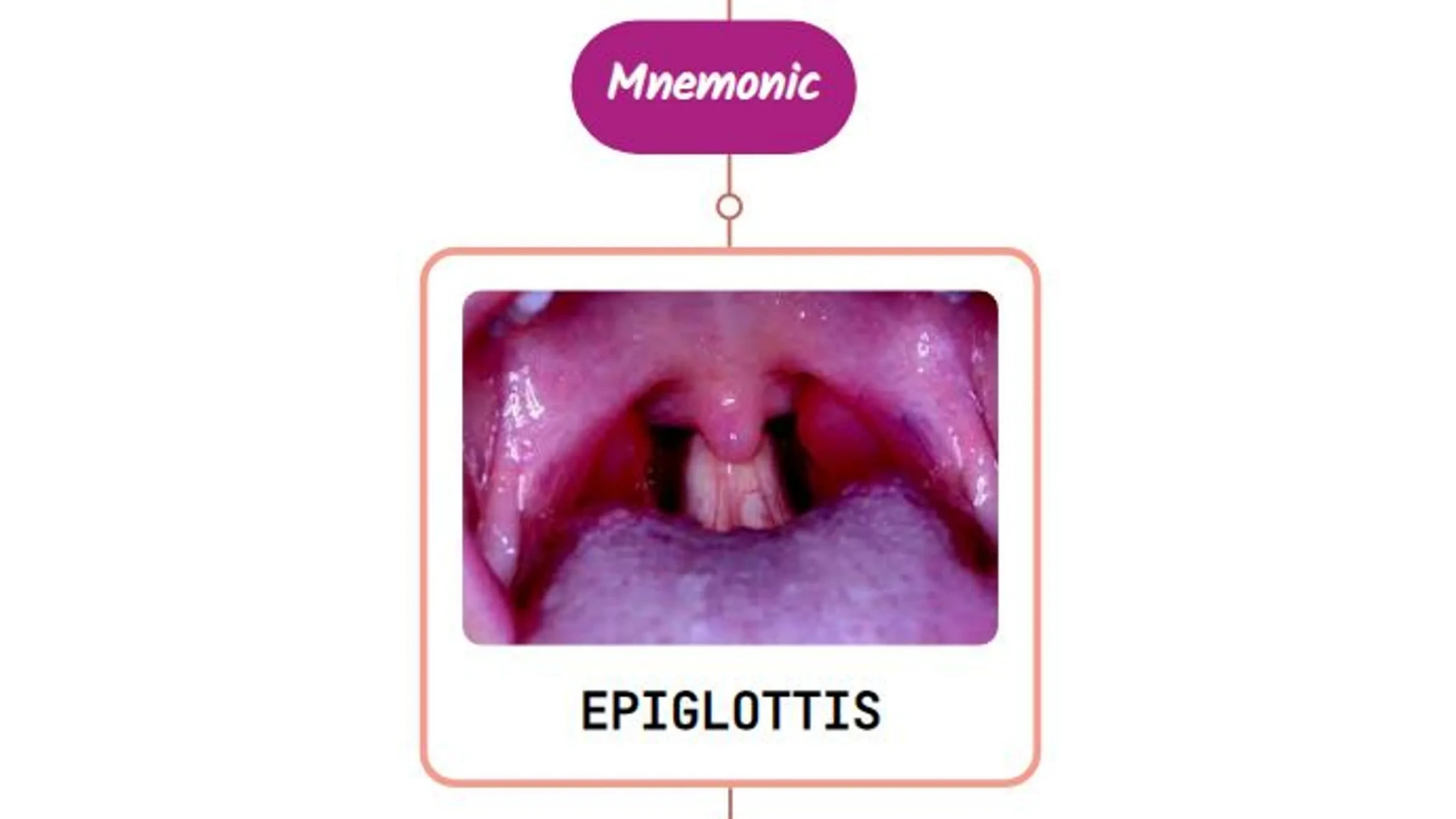You are currently viewing Epiglottitis – Mnemonic