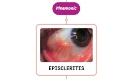 Episcleritis Mnemonic