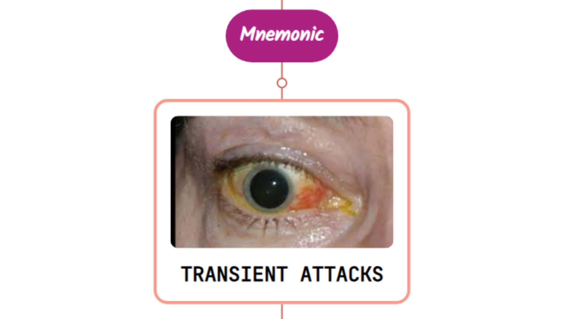 You are currently viewing Eye Symptoms In Transient Ischemic Attacks – Mnemonic