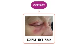 Herpes Simplex Infection In Eye Mnemonic