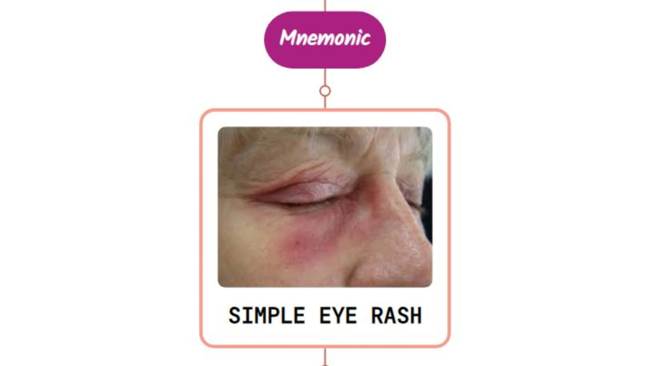 You are currently viewing Herpes Simplex Infection In Eye Mnemonic