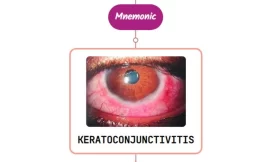 Keratoconjunctivitis Sicca Mnemonic