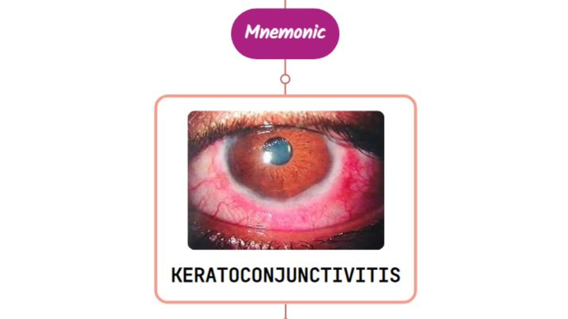 You are currently viewing Keratoconjunctivitis Sicca Mnemonic