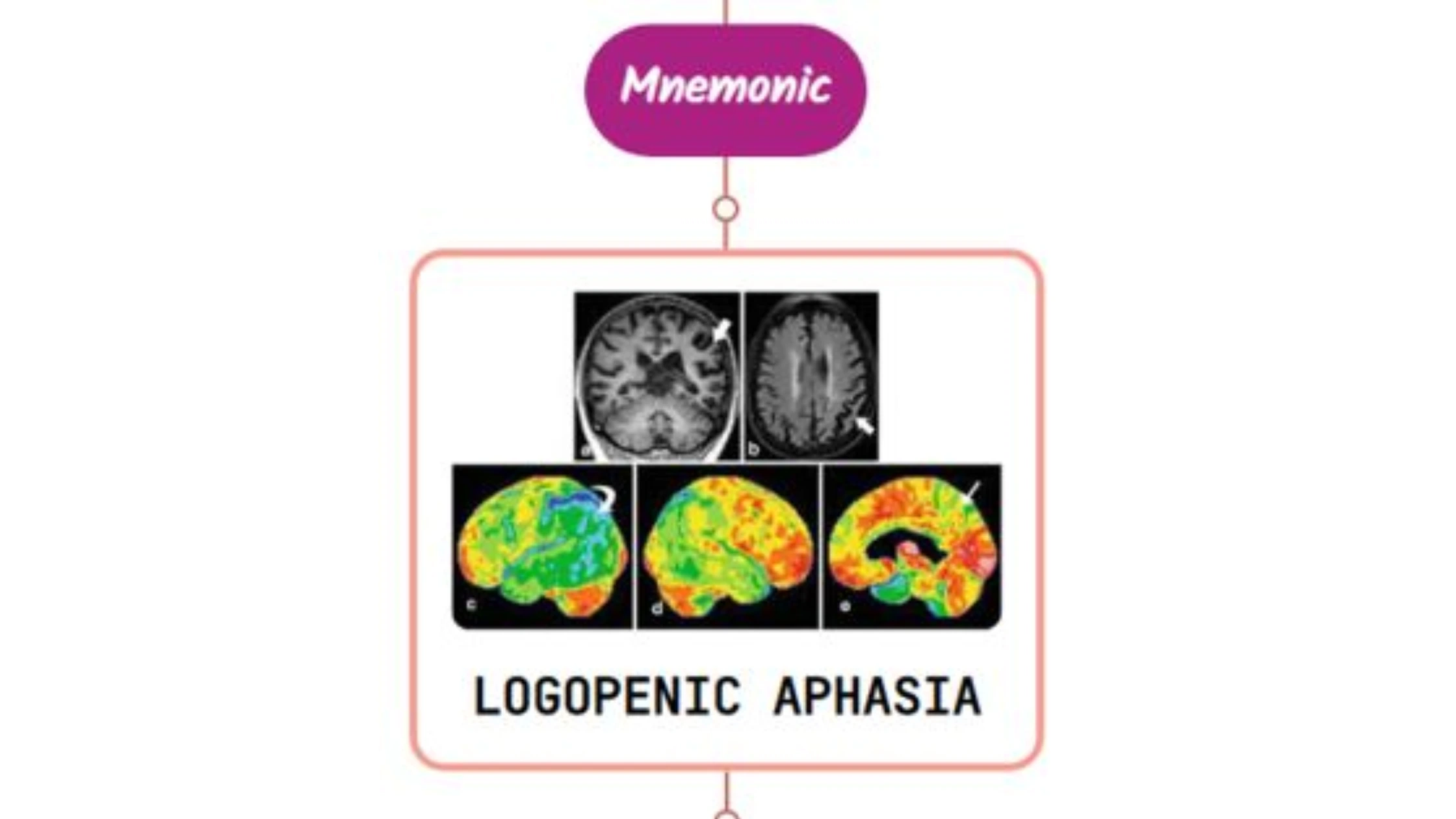 You are currently viewing Logopenic Primary Progressive Aphasia Mnemonic