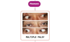Multiple Ocular Motor Nerve Palsies – Mnemonic