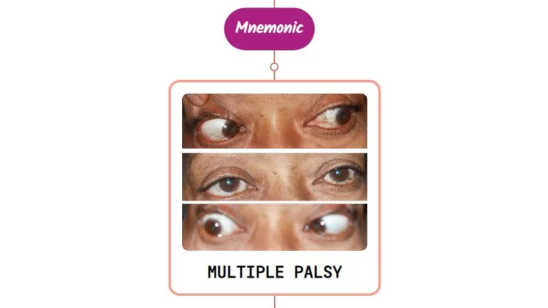 Read more about the article Multiple Ocular Motor Nerve Palsies – Mnemonic