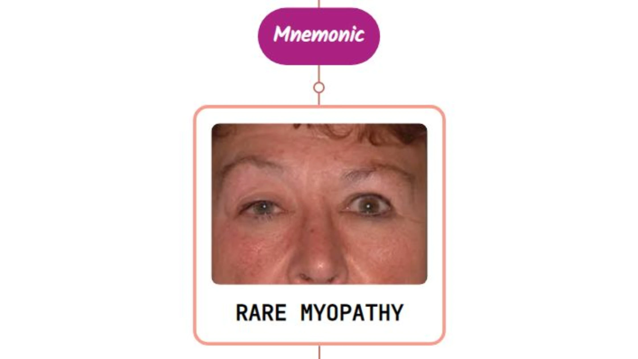You are currently viewing Myogenic Ptosis – Mnemonic