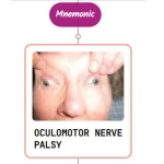 Read more about the article Oculomotor Nerve Disorder – Mnemonic