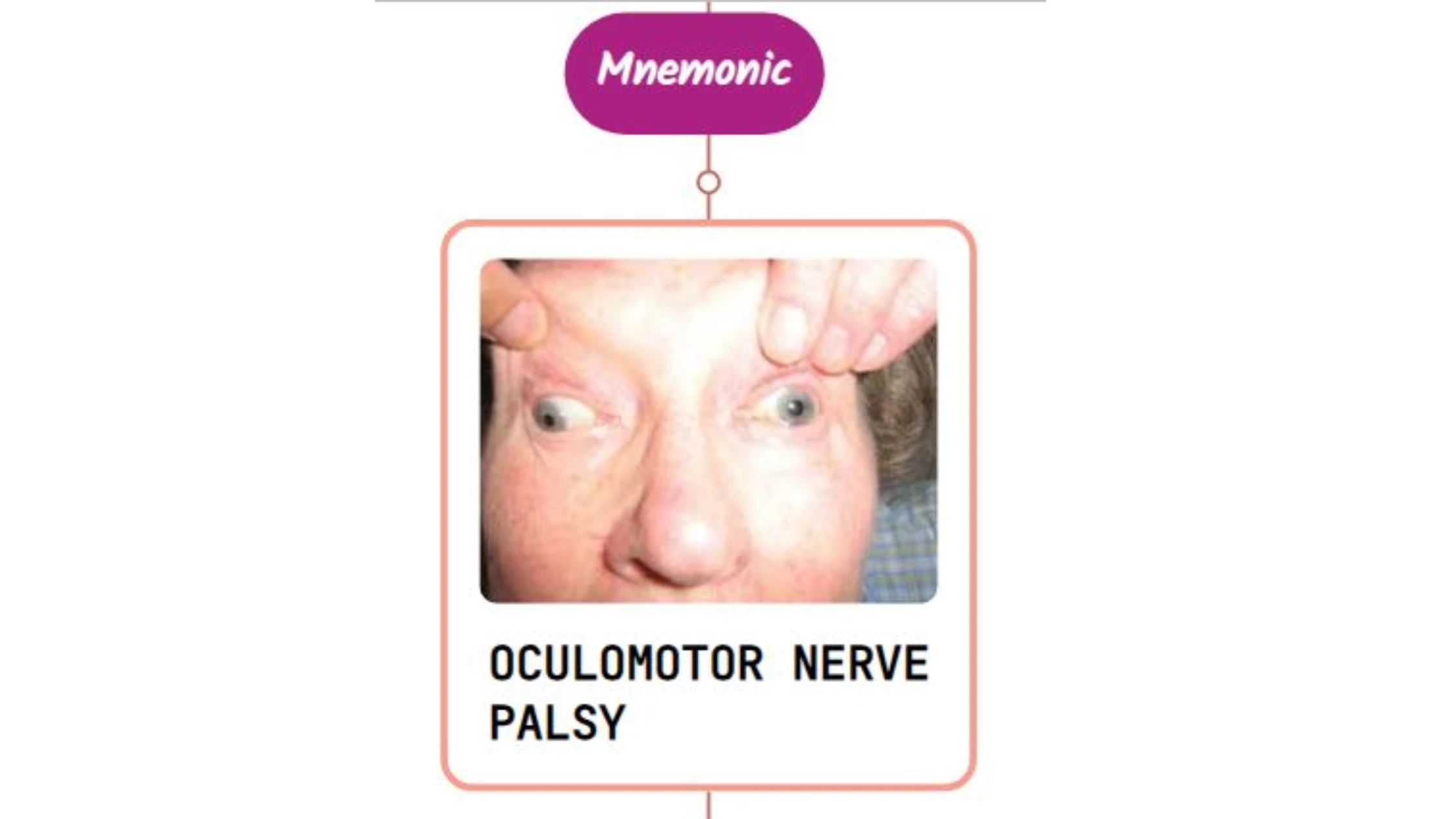 You are currently viewing Oculomotor Nerve Disorder – Mnemonic