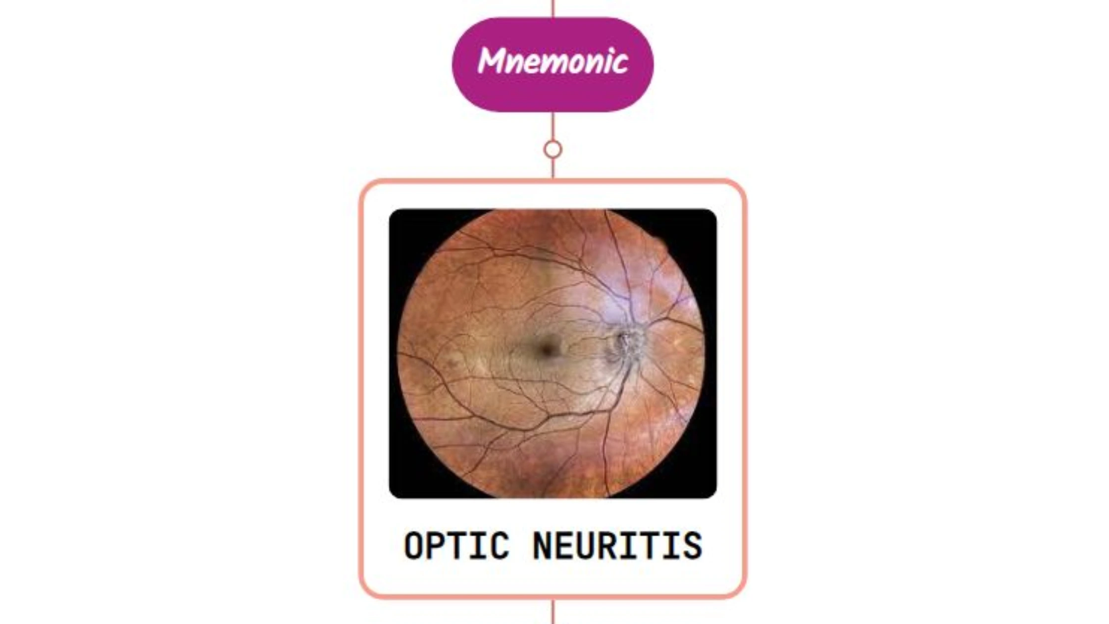 You are currently viewing Optic Neuritis Mnemonic