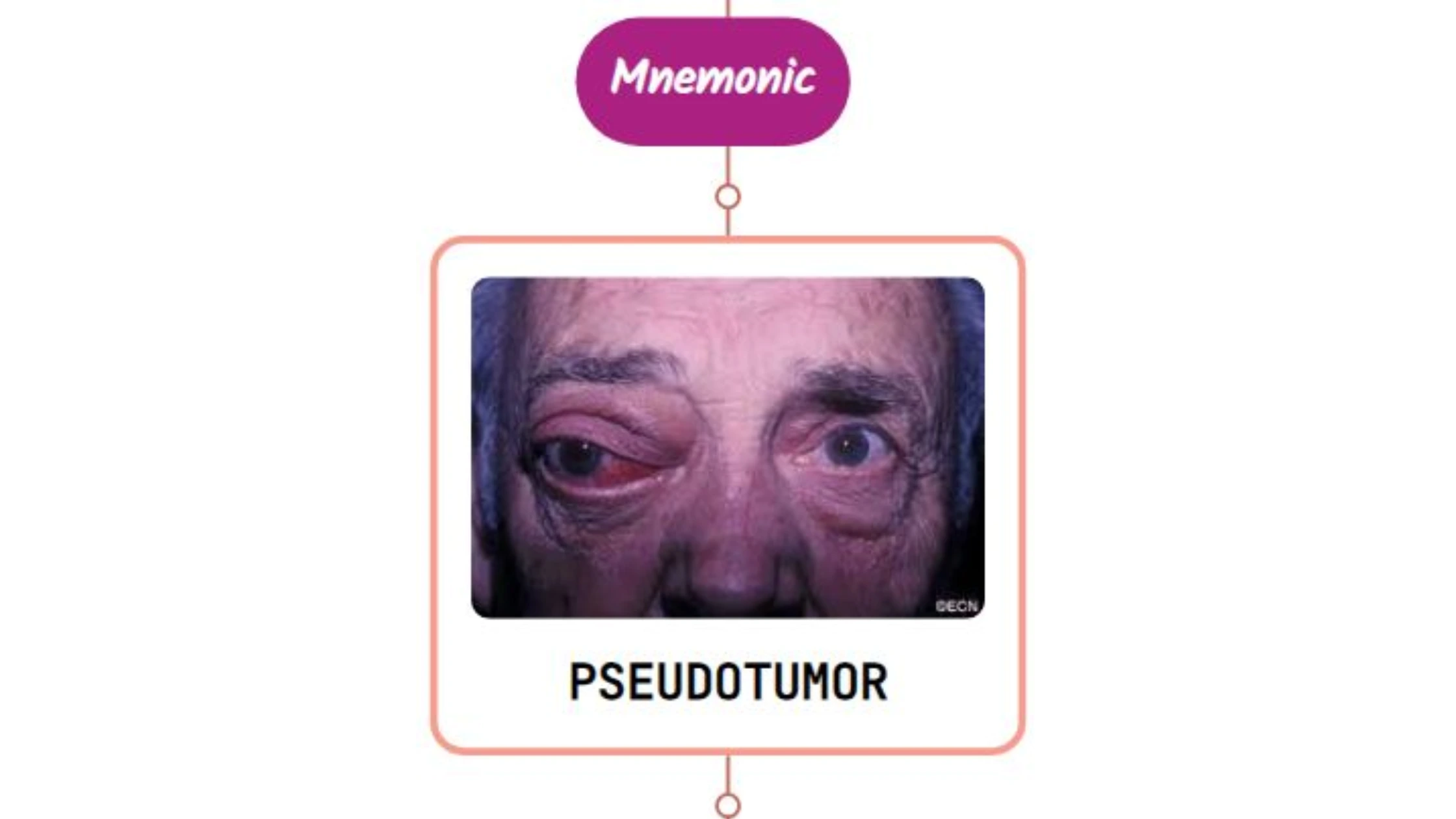 You are currently viewing Orbital Pseudotumor – Mnemonic