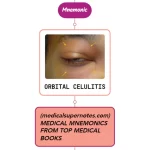 Read more about the article Orbital Cellulitis – Mnemonic