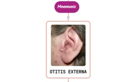 Otitis Externa – Mnemonic