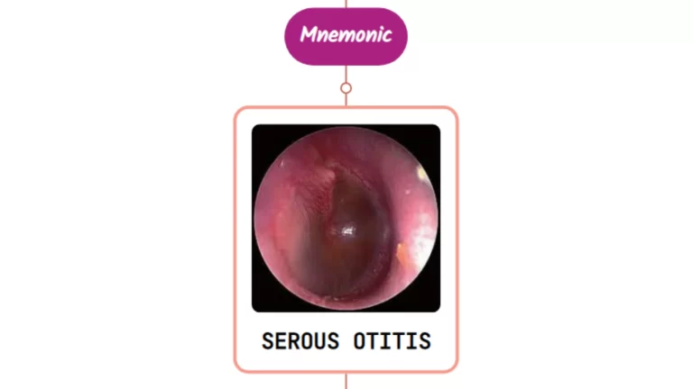 Read more about the article Otitis Media With Effusion – Mnemonic