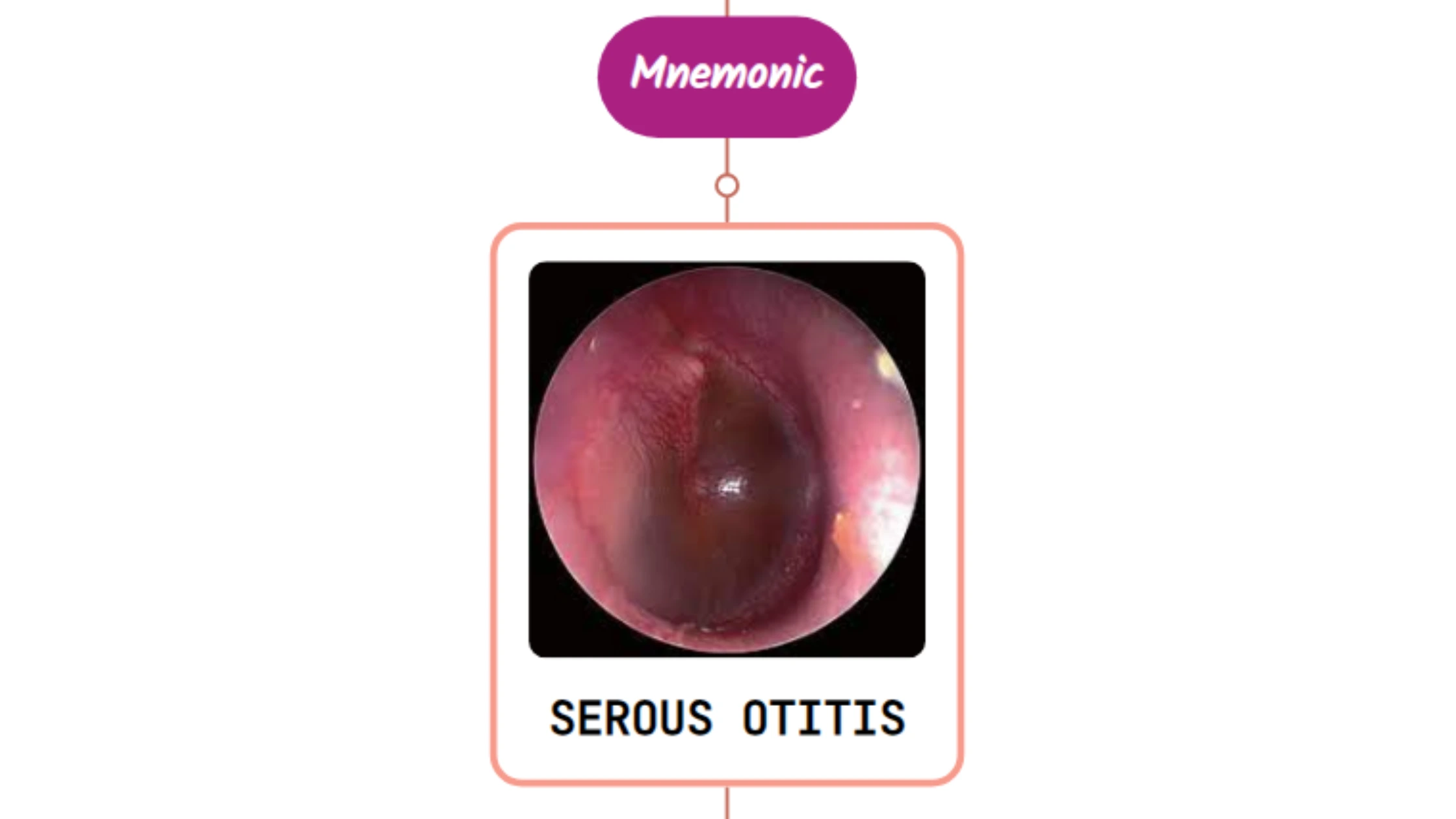 You are currently viewing Otitis Media With Effusion – Mnemonic