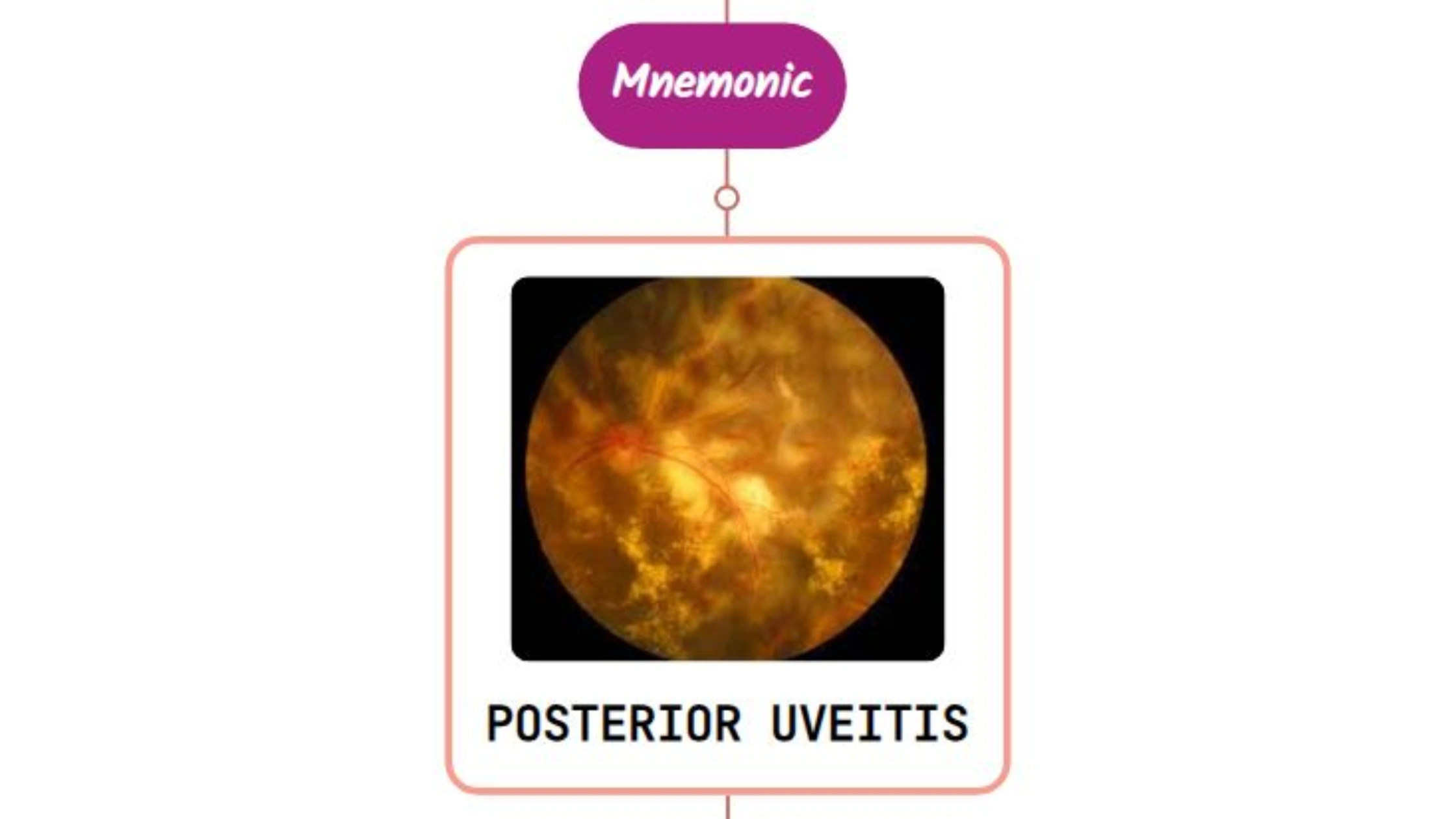 You are currently viewing Posterior Uveitis Mnemonic