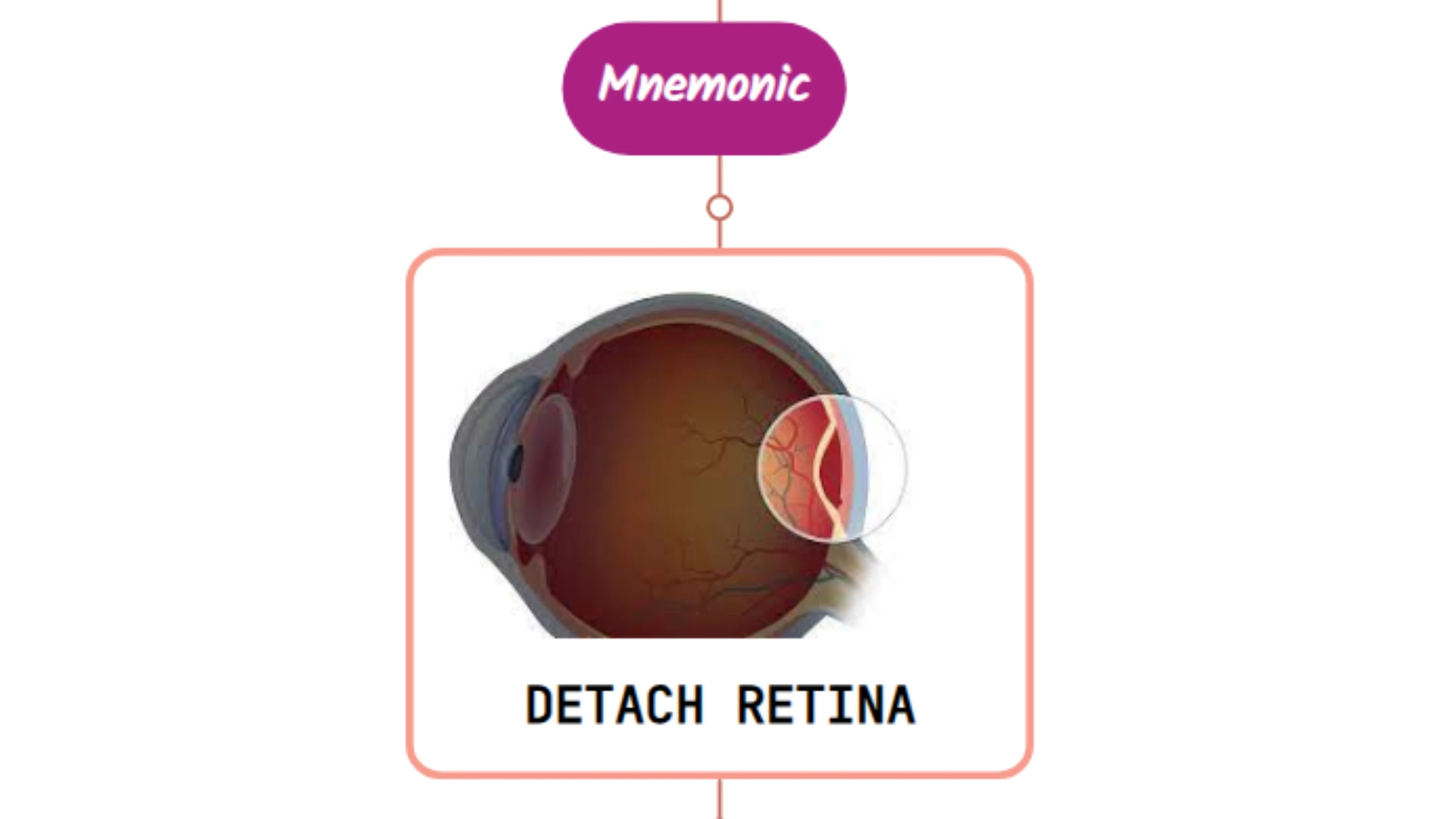You are currently viewing Retinal Detachment Mnemonic