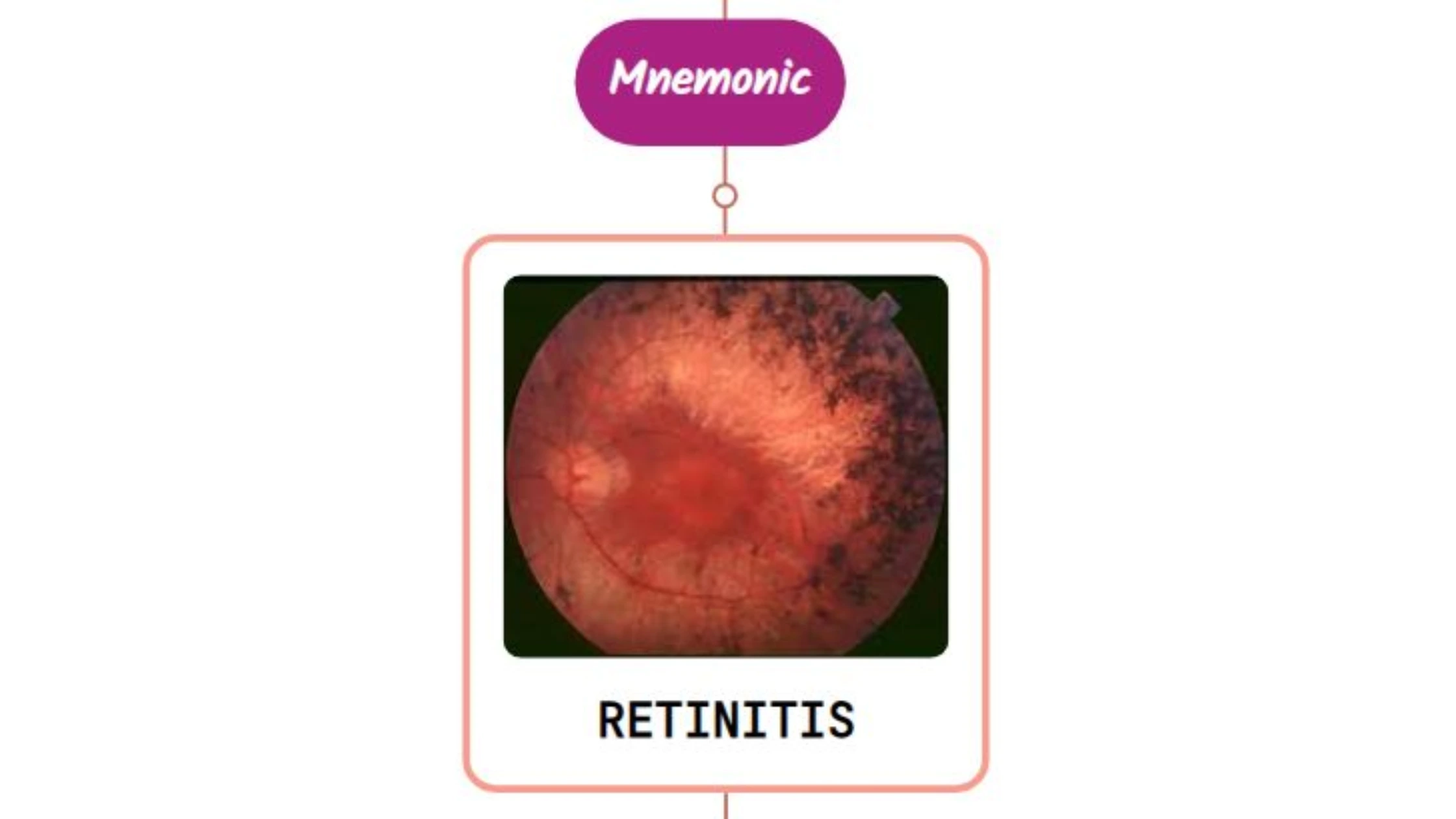 You are currently viewing Retinitis Pigmentosa – Mnemonic