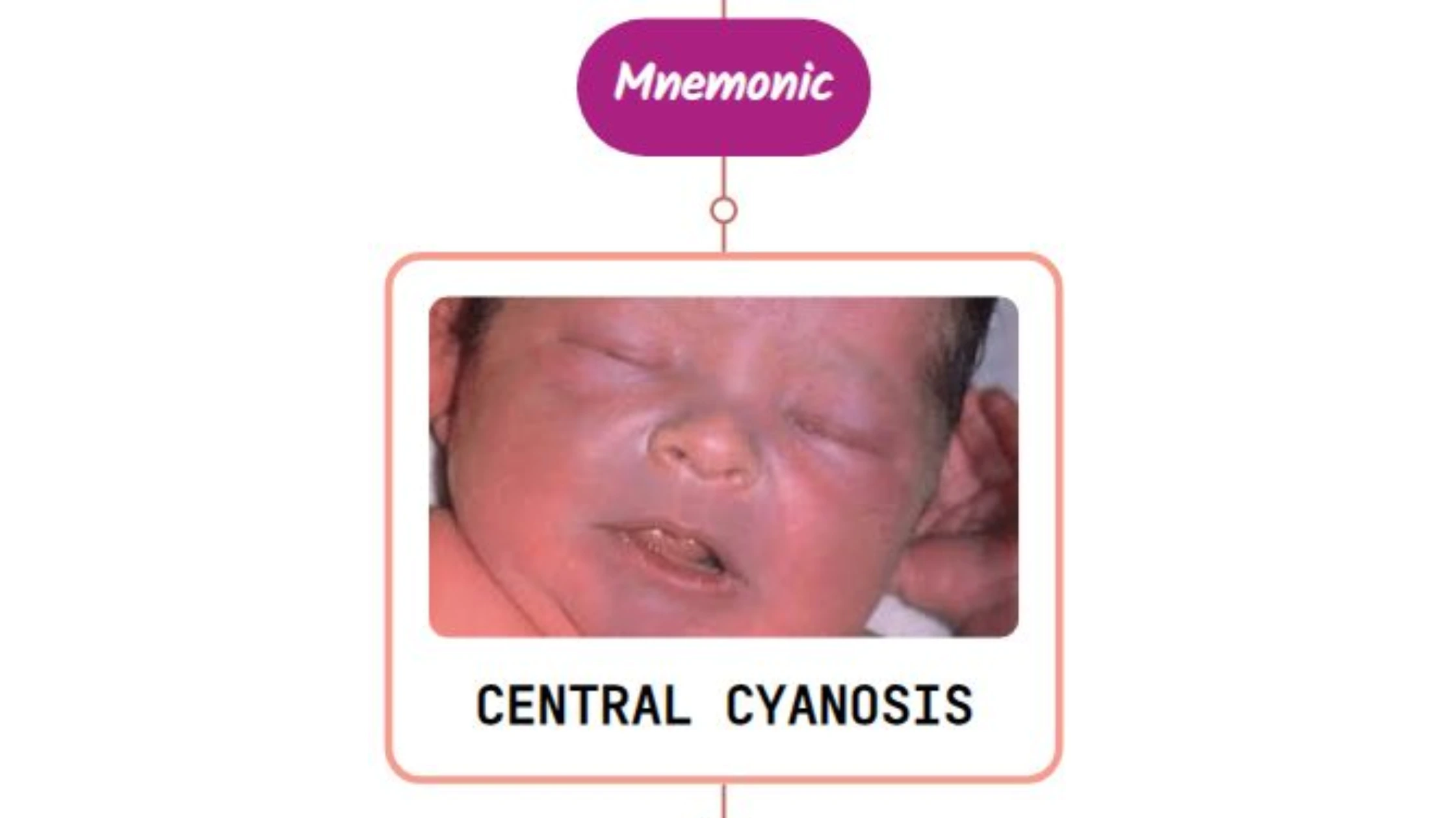 You are currently viewing Central Cyanosis – Mnemonic