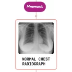 Read more about the article Chronic Cough With A Normal Chest Radiograph – Mnemonic