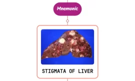 Stigmata/Signs Of Liver Disease – Mnemonic [Never Forget Again]
