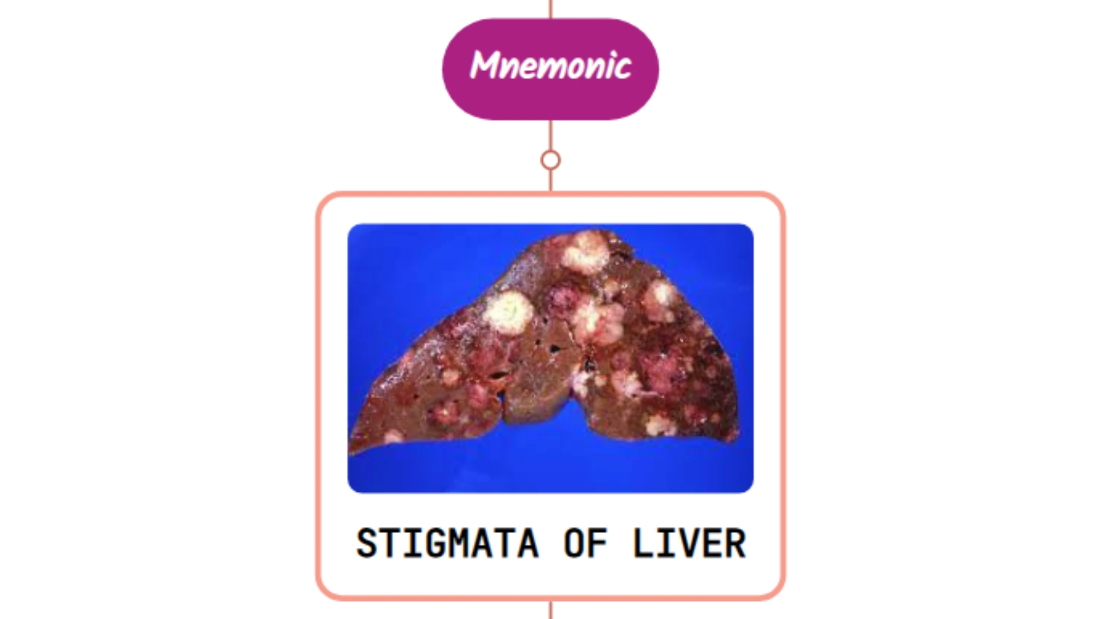 You are currently viewing Stigmata/Signs Of Liver Disease – Mnemonic [Never Forget Again]